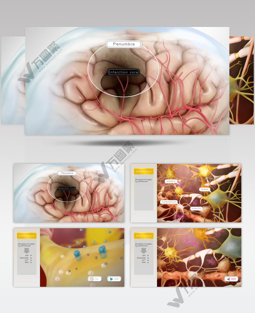 脑中风后的恢复人体医疗三维机理动画视频素材