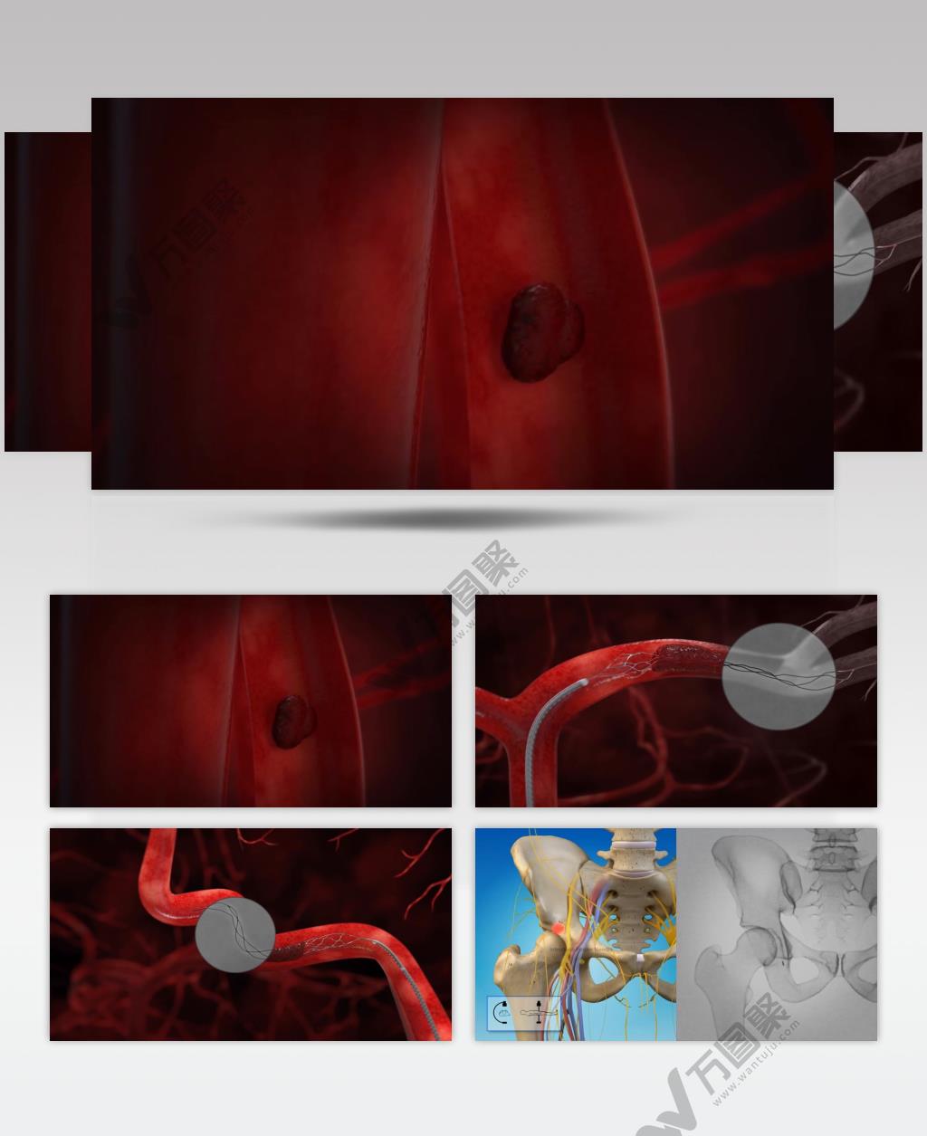 软化血管血栓疏通医学三维动画视频素材