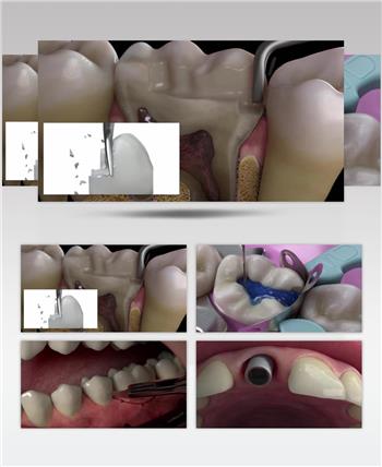 种植牙三维演示动画 牙齿牙科